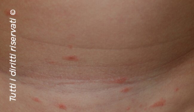 Pityriasis rosea