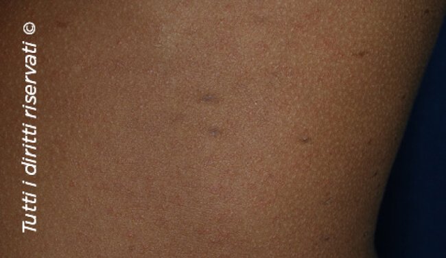 Pityriasis rosea