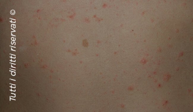 Pityriasis rosea