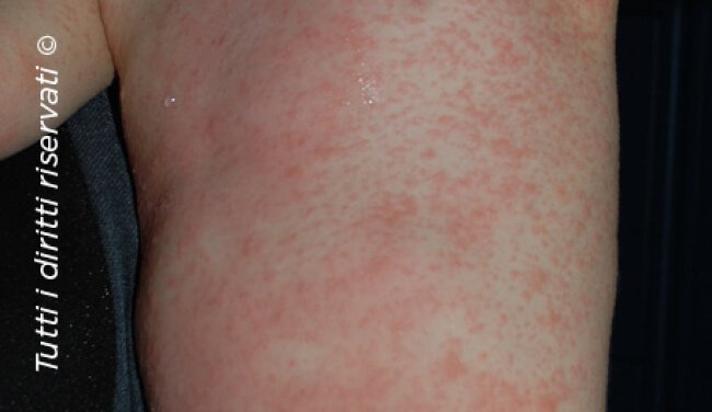 Pityriasis rosea