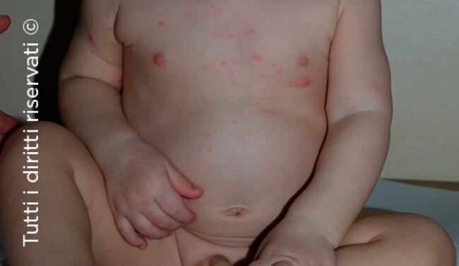 Scabies