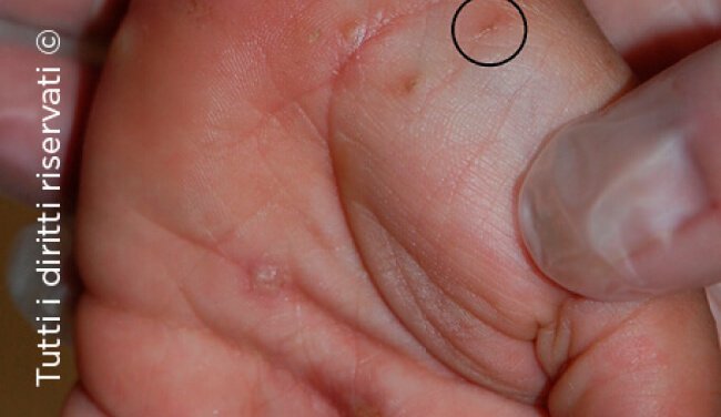 Scabies