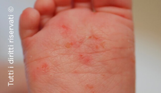 Scabies