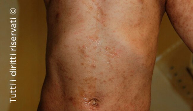 Scabies