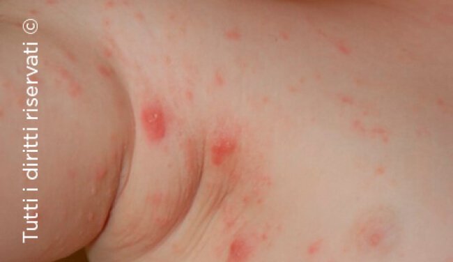 Scabies