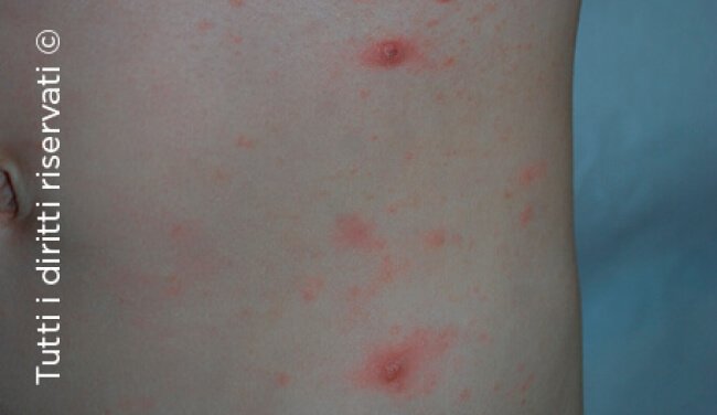 Scabies