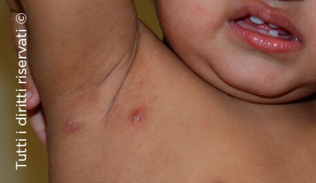 Scabies