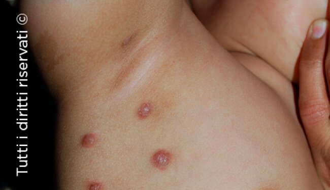 Scabies