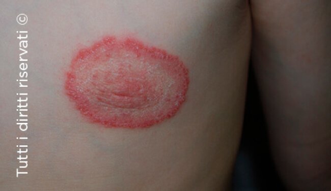 Tinea