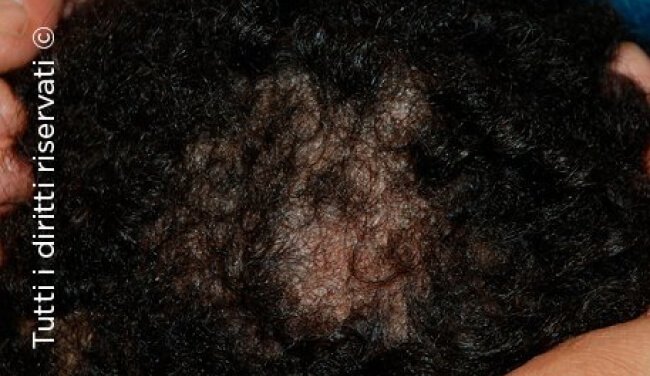 Tinea
