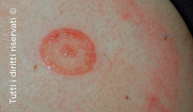 Tinea