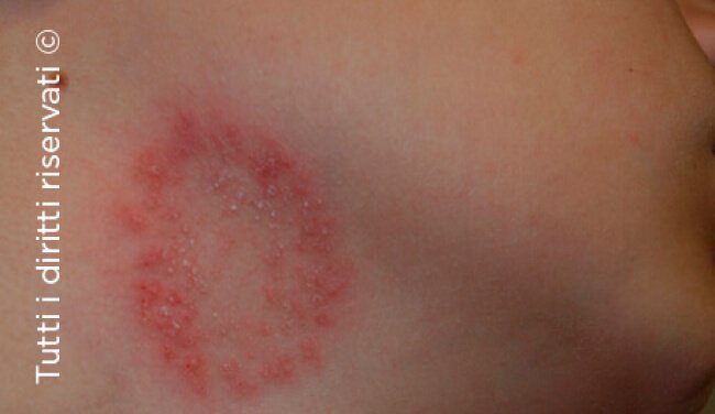 Tinea