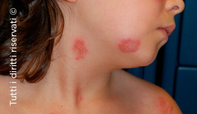 Tinea