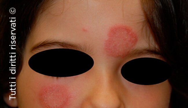 Tinea