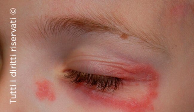 Tinea