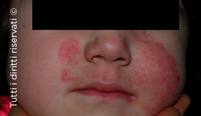 Tinea