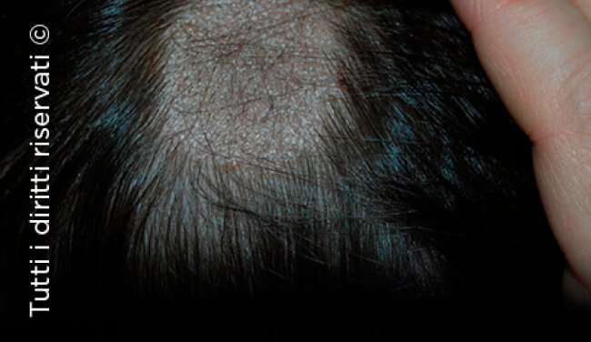 Tinea