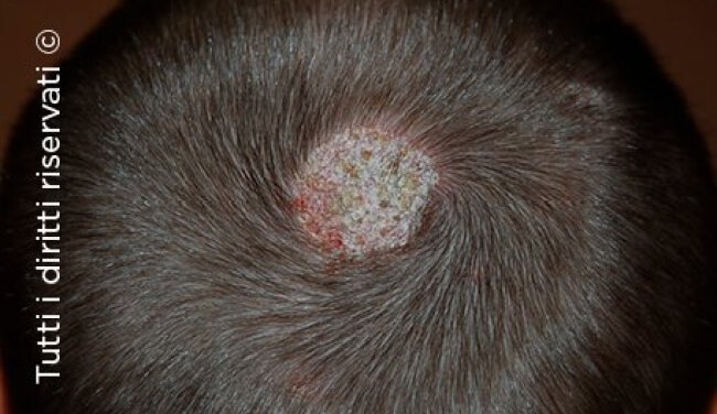Tinea