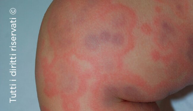Urticaria