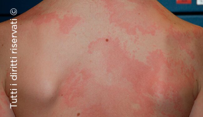 Urticaria