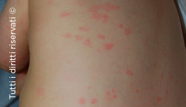 Urticaria