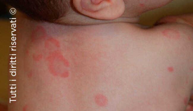 Urticaria