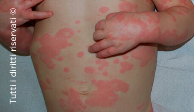 Urticaria