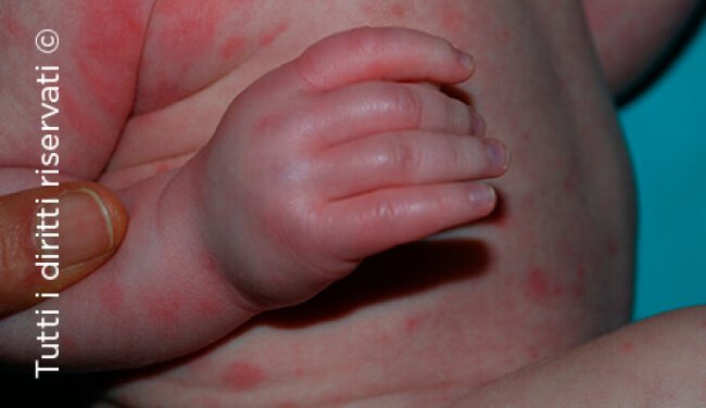 Urticaria