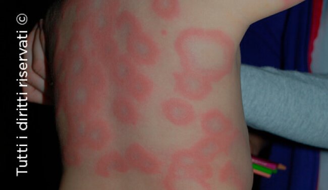 Urticaria