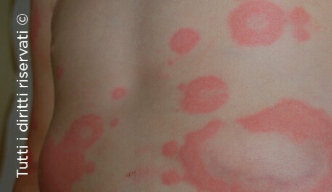 Urticaria