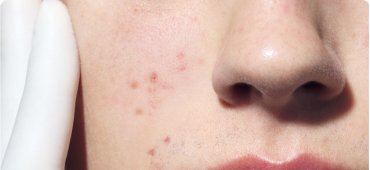 Atopic Dermatitis