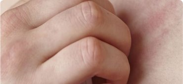 Atopic Dermatitis