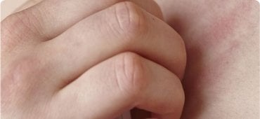 Atopic Dermatitis