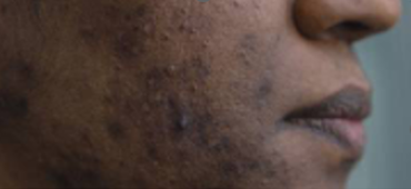Pigmentation
