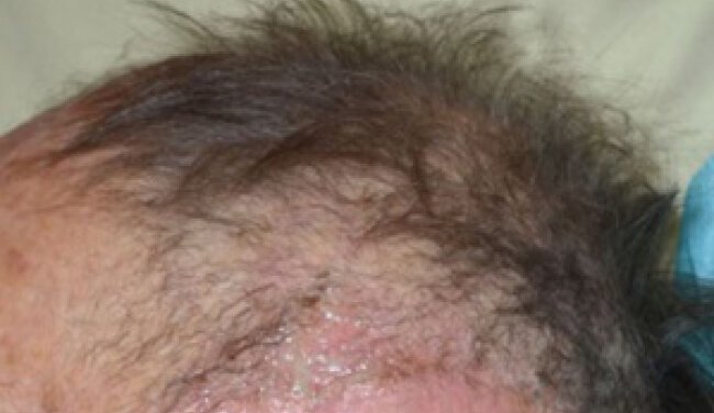 Abnormal hair texture