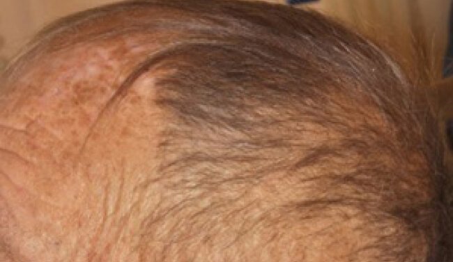 Abnormal hair texture