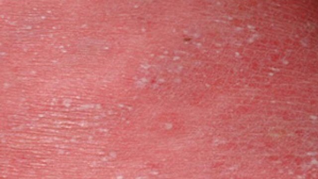 Acute generalized exanthematous pustulosis