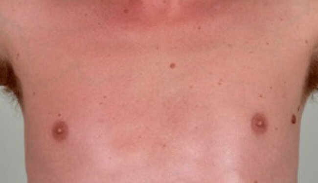 Sindrome dress (rash da farmaci con eosinofilia e sintomi sistemici) o sindrome da iper-sensibilità farmaco-indotta