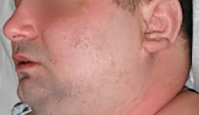 Sindrome dress (rash da farmaci con eosinofilia e sintomi sistemici) o sindrome da iper-sensibilità farmaco-indotta