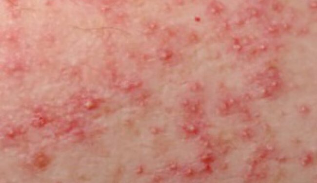 Folliculitis