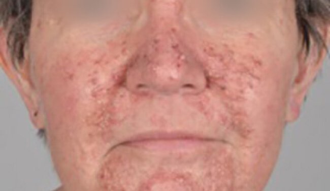 Folliculitis