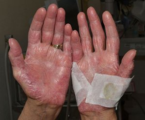 Hand-foot syndrome