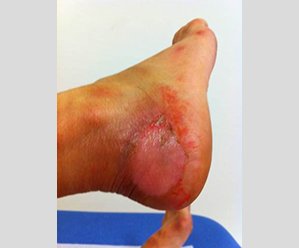 Hand-foot syndrome