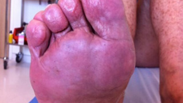 Hand-foot syndrome