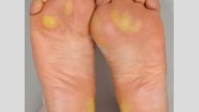 Hyperkeratotic hand-foot syndrome