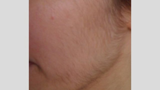 Hypertrichosis