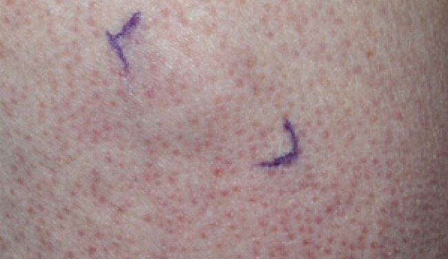 Keratosis pilaris