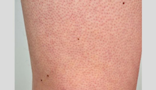 Keratosis pilaris
