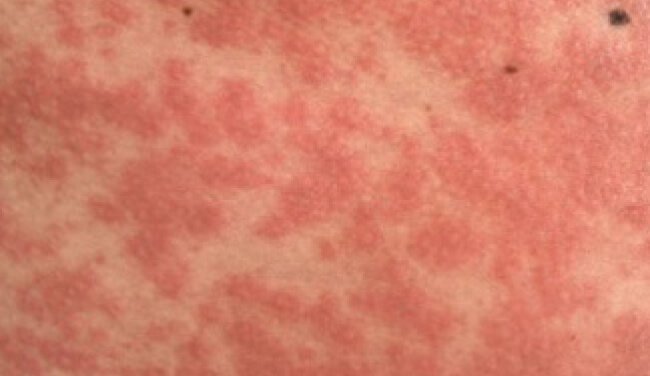 Maculo-papilar rash