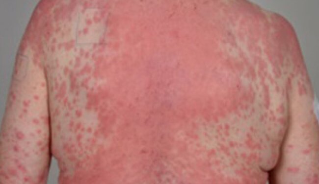 Maculo-papilar rash
